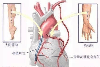 什么是心肌梗死? 为家人看看吧