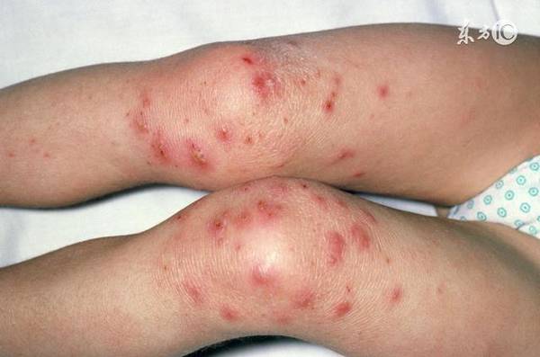 去湿热效果极好,湿热一去,相关的症状如发胖,痘痘,白带多,湿疹,至瘤