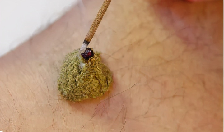 1,艾炷非化脓灸(无瘢痕灸)点击加载图片目前比较常用的方法有以下几种