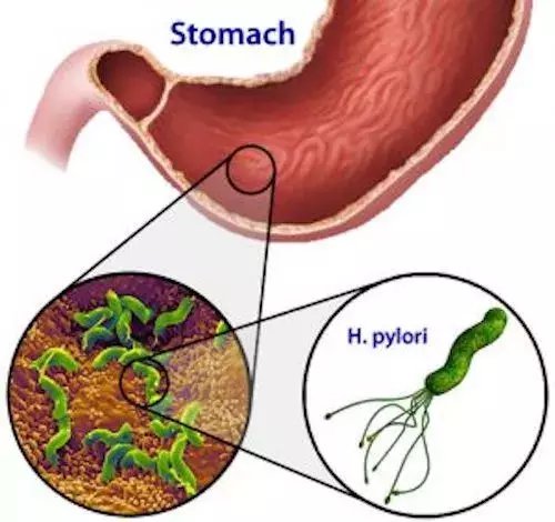 食道中分化癌属于几期_食道癌放疗一次要多少钱_食道上段癌的症状