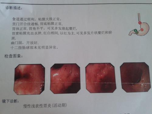 3種最常見的胃病, 尤其是第1種, 不注意容易小心癌變!