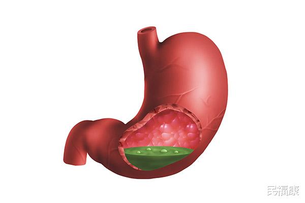 I always feel acid reflux and heartburn, what should I do? After gastroesophageal reflux disease appears, it is recommended to do 4 things