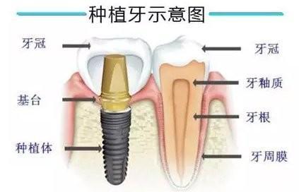 种植牙后万事大吉? 请待它如“真牙”般温柔