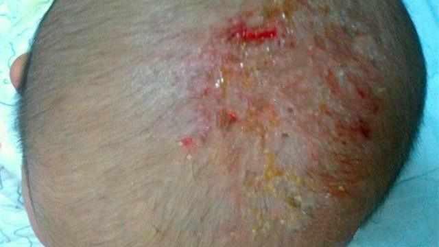 2月宝宝长舅舅屎, 妈妈碰了碰把宝宝送进医院