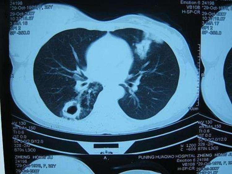 肺结核分阴虚肺燥型及阴阳两虚型