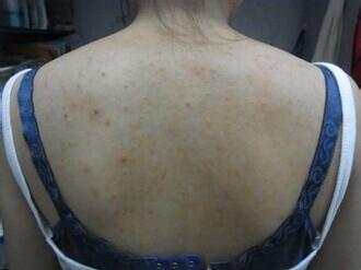 后背长的小米粒是什么? 很影响美观, 挤出来