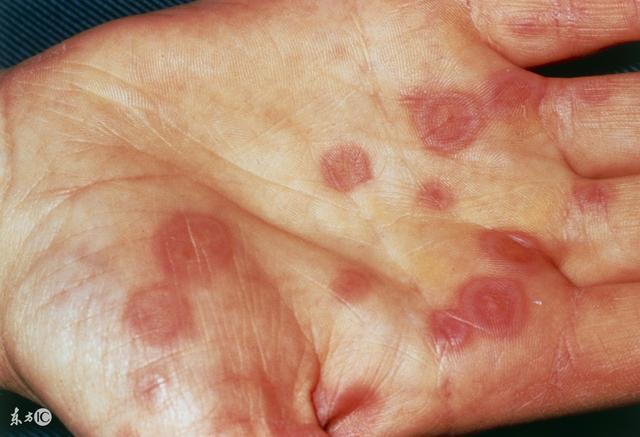 不幸患了多形红斑怎么办