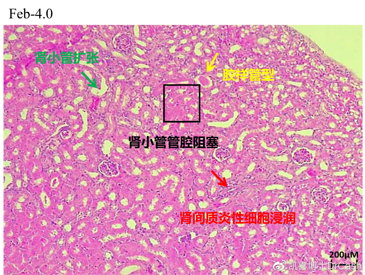 4mg/kg剂量组的肾脏切片中,可以看到:部分肾间质炎性细胞浸润,部分肾