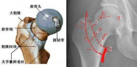 股骨頸骨折後為什麼會引發股骨頭壞死?