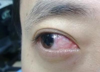 医生告诫: 眼睛出现这3种异常变化, 当心你的肝脏出问题! 需警惕