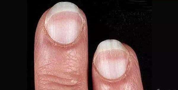 30来岁小伙检查出肝癌晚期! 医生: 你的指甲有这些预示吗?