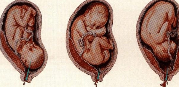 胎盘畸形图片