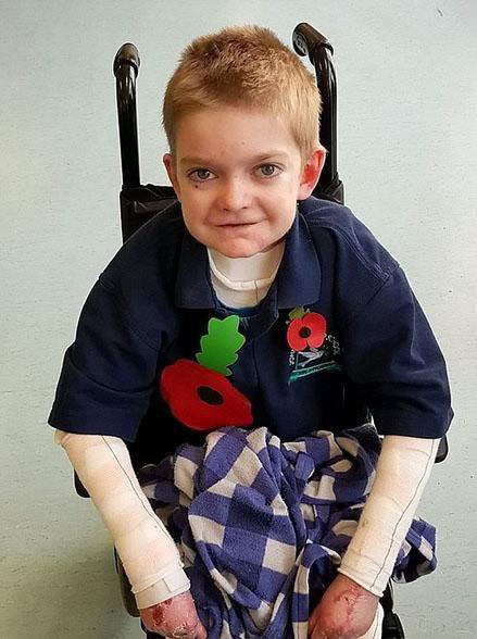 英11岁男孩患罕见疾病皮肤一碰就溃烂