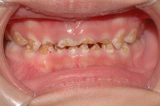 无知妈妈贪一时的轻松, 4岁宝宝牙齿毁掉一半!