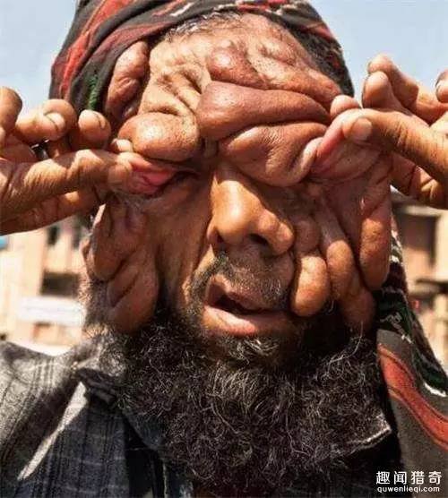 拾荒的怪脸男和独腿妻子生下健康女儿