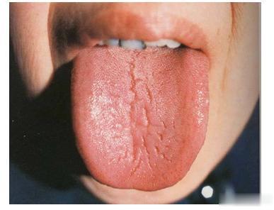 舌苔边缘有齿痕, 舌苔中间有裂纹是什么原因? 医生来解释