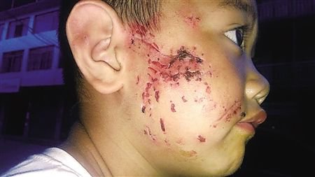 重庆奉节6岁留守儿童独自在家被狗咬烂脸