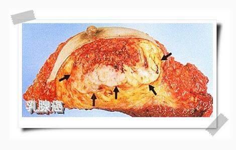 乳腺癌腦轉移大數據:有數據表示,腦轉移腫瘤中有5成來源肺癌,而有3成