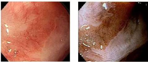 常见的内镜染色方法原理,内镜下表现